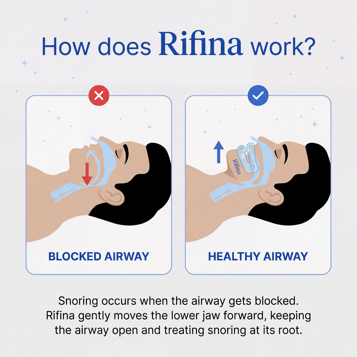 How the anti snoring mouthpiece works